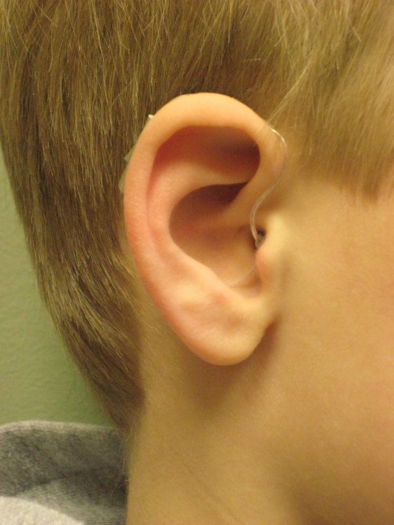Behind the Ear (BTE) Hearing Aid